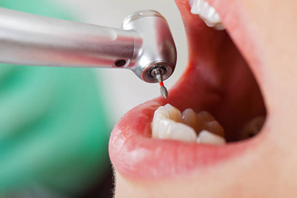 Best Knocked-Out Tooth (Avulsed Tooth) Treatment in Key Center, WA